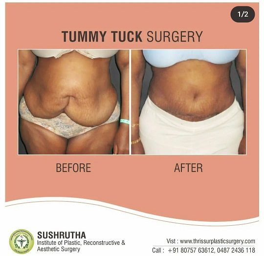 Liposuction vs Tummy Tuck (Abdominoplasty)