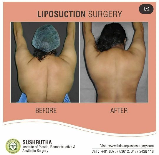 Liposuction Thrissur, Lipoplasty India, Body Contouring Kerala