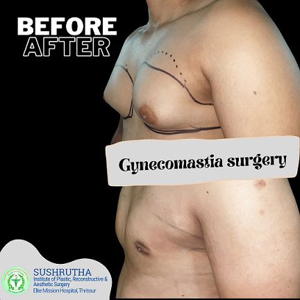 Breast reduction surgery (female)/Gynecomastia surgery (male