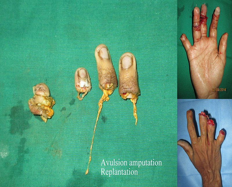 Finger Prosthetic - Azouz Hand SurgeryAzouz Hand Surgery