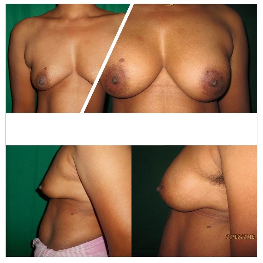 breast implant surgery before & after