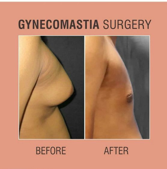 gynecomastia surgery before after