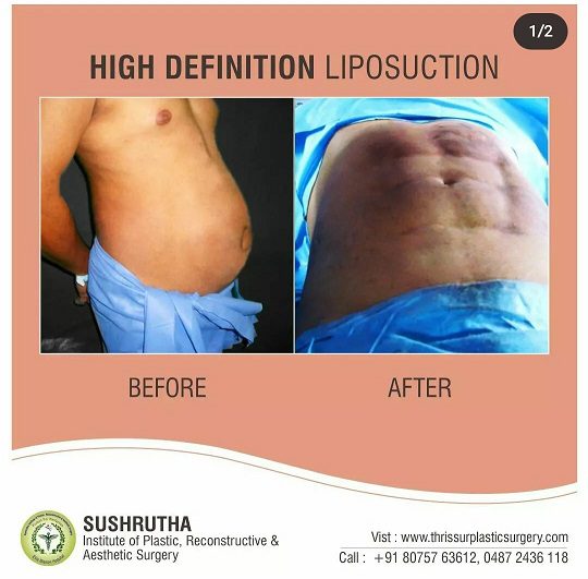 hd liposuction kerala