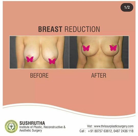 breast reduction before and after