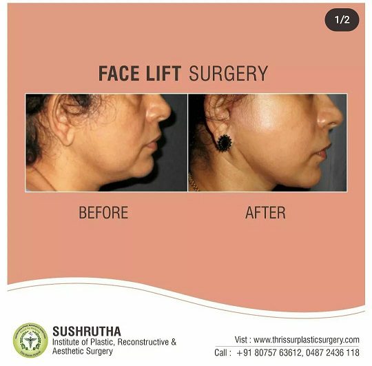 face lift before and after