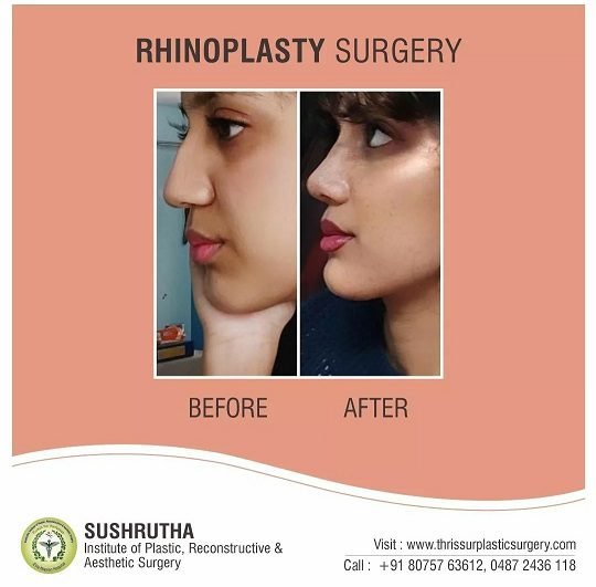 rhinoplasty before and after