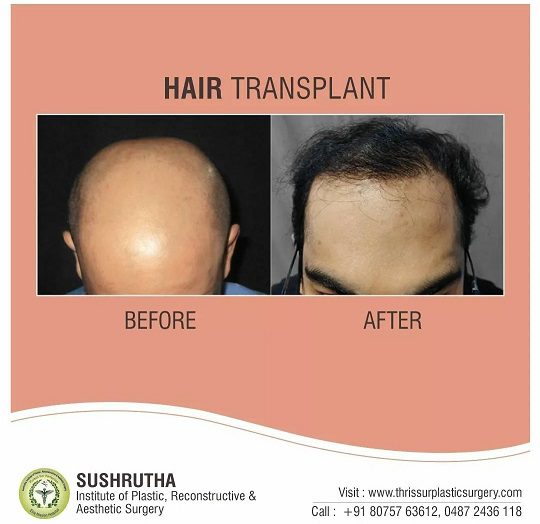 hair transplant before and after