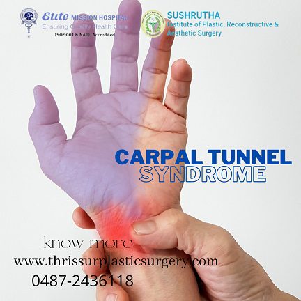 carpal tunnel syndrome treatment