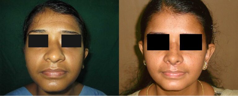 rhinoplasty before and after