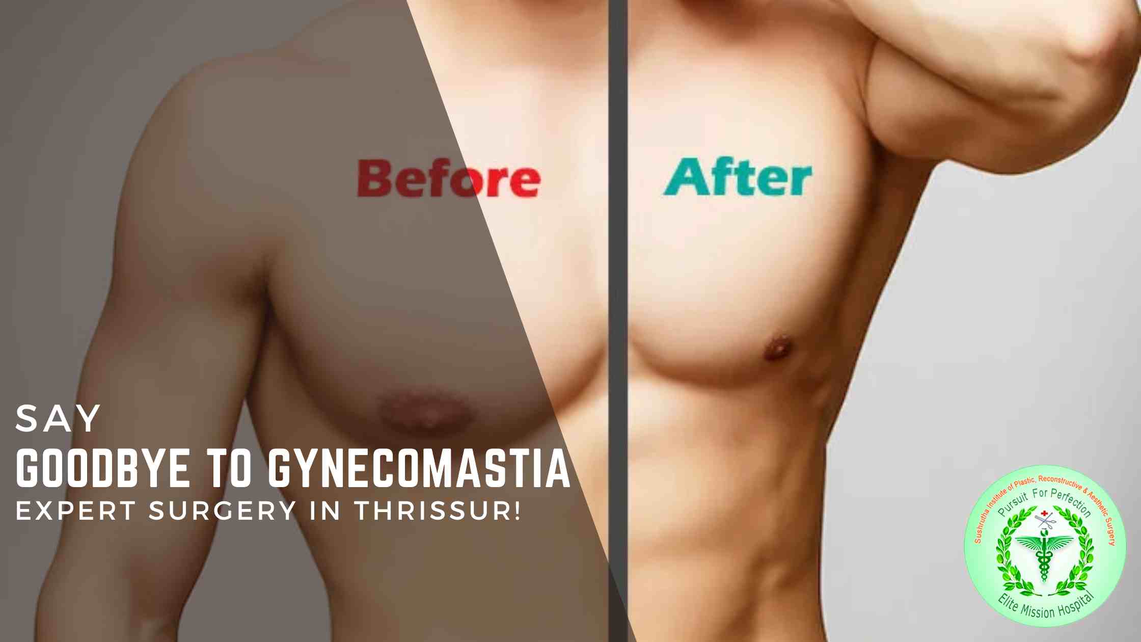 Gynecomastia surgery in Thrissur for a confident, natural chest contour.