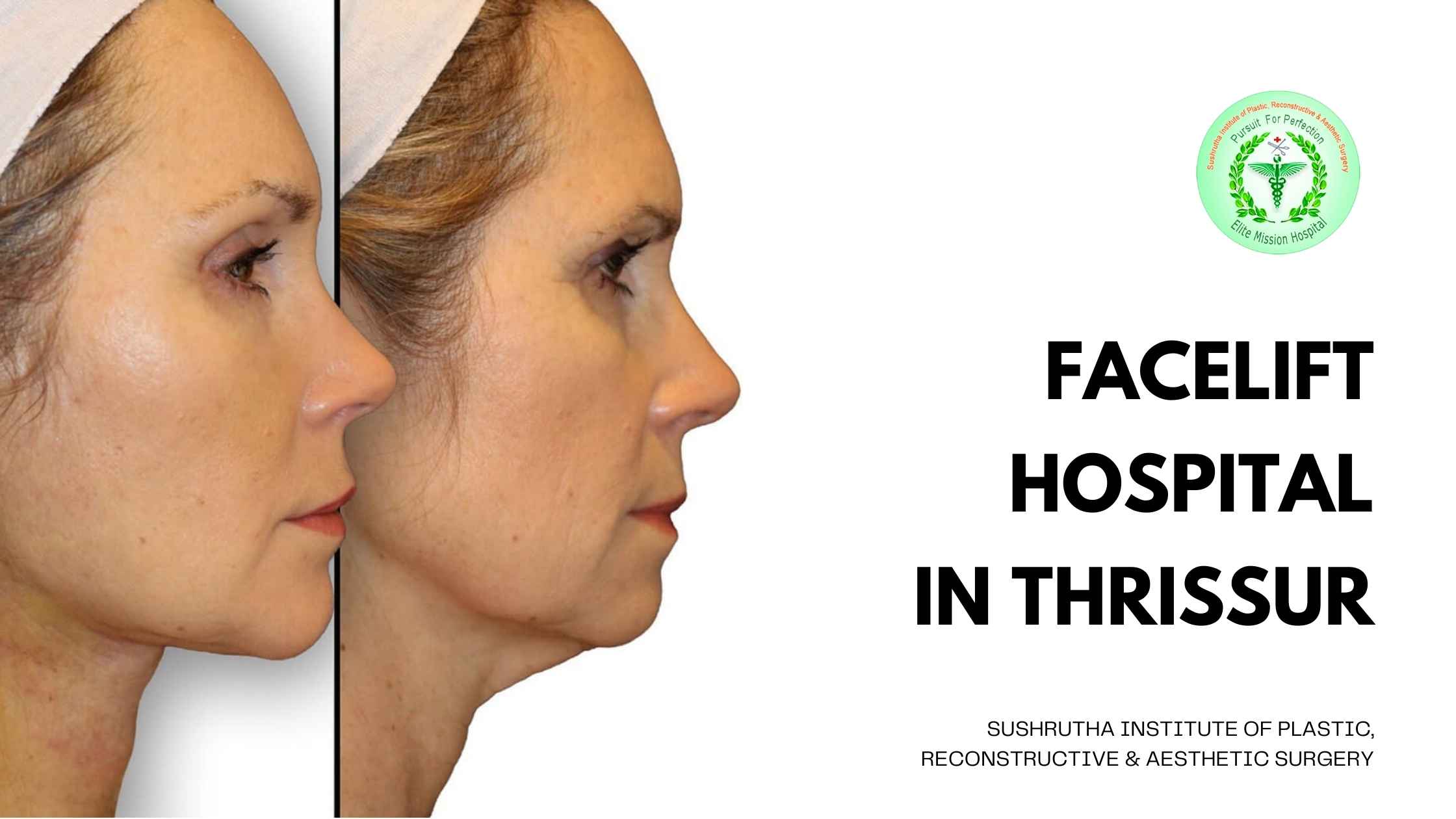 Facelift surgery at Sushrutha Institute of Plastic, Reconstructive & Aesthetic Surgery in Thrissur, Kerala