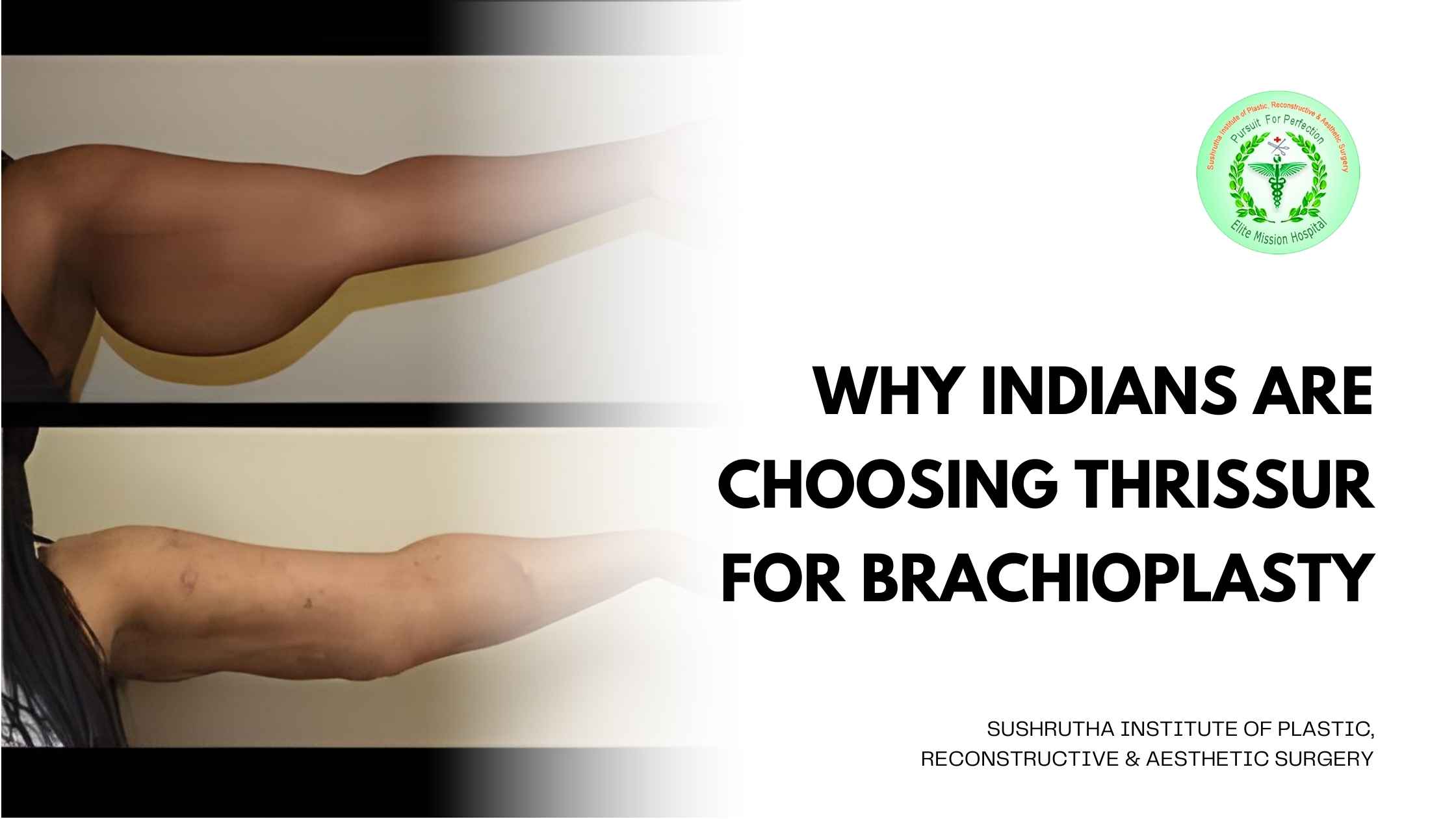 Brachioplasty surgery in Thrissur, India for arm contouring