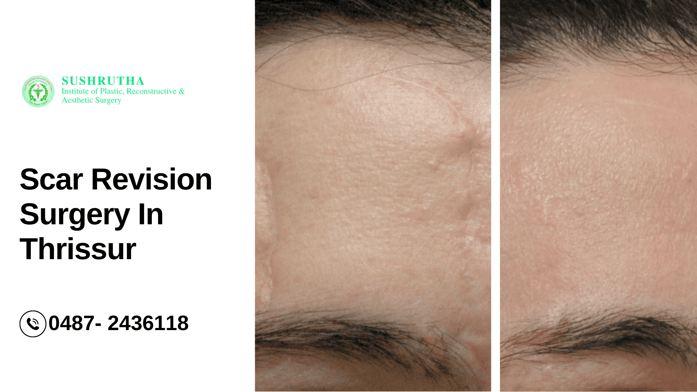 Get the best scar revision surgery in Thrissur at Sushrutha Institute for a smooth, confident skin transformation.