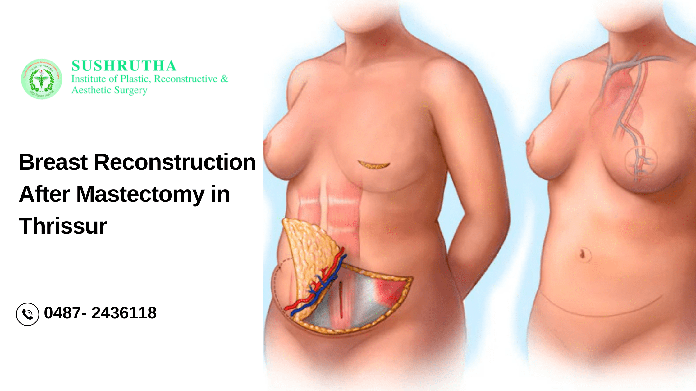 Expert breast reconstruction after mastectomy in Thrissur – Advanced surgical solutions at Sushrutha Institute for natural and confident recovery."