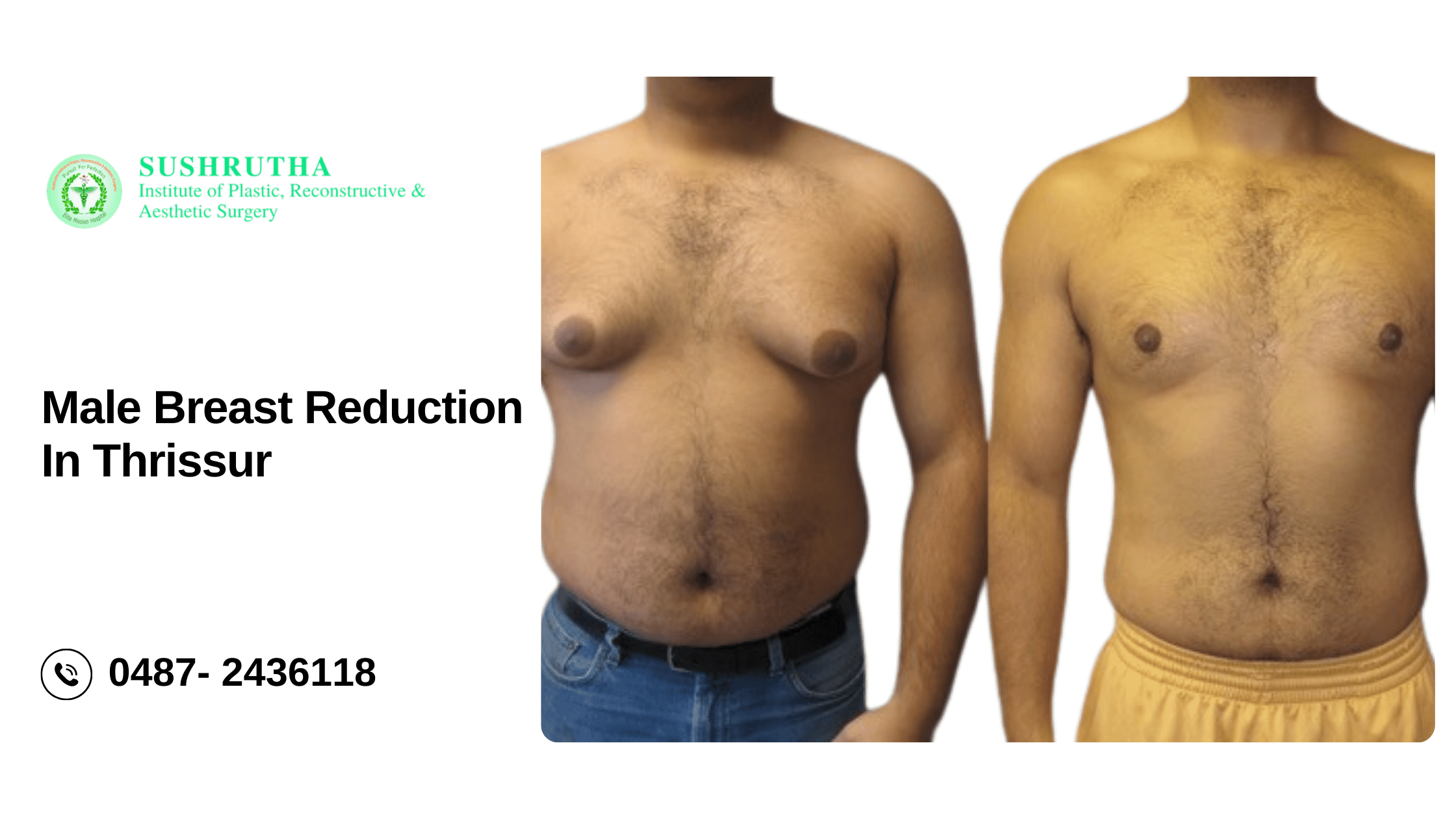 "Before and after results of male breast reduction in Thrissur at Sushrutha Institute – Achieve a sculpted chest."