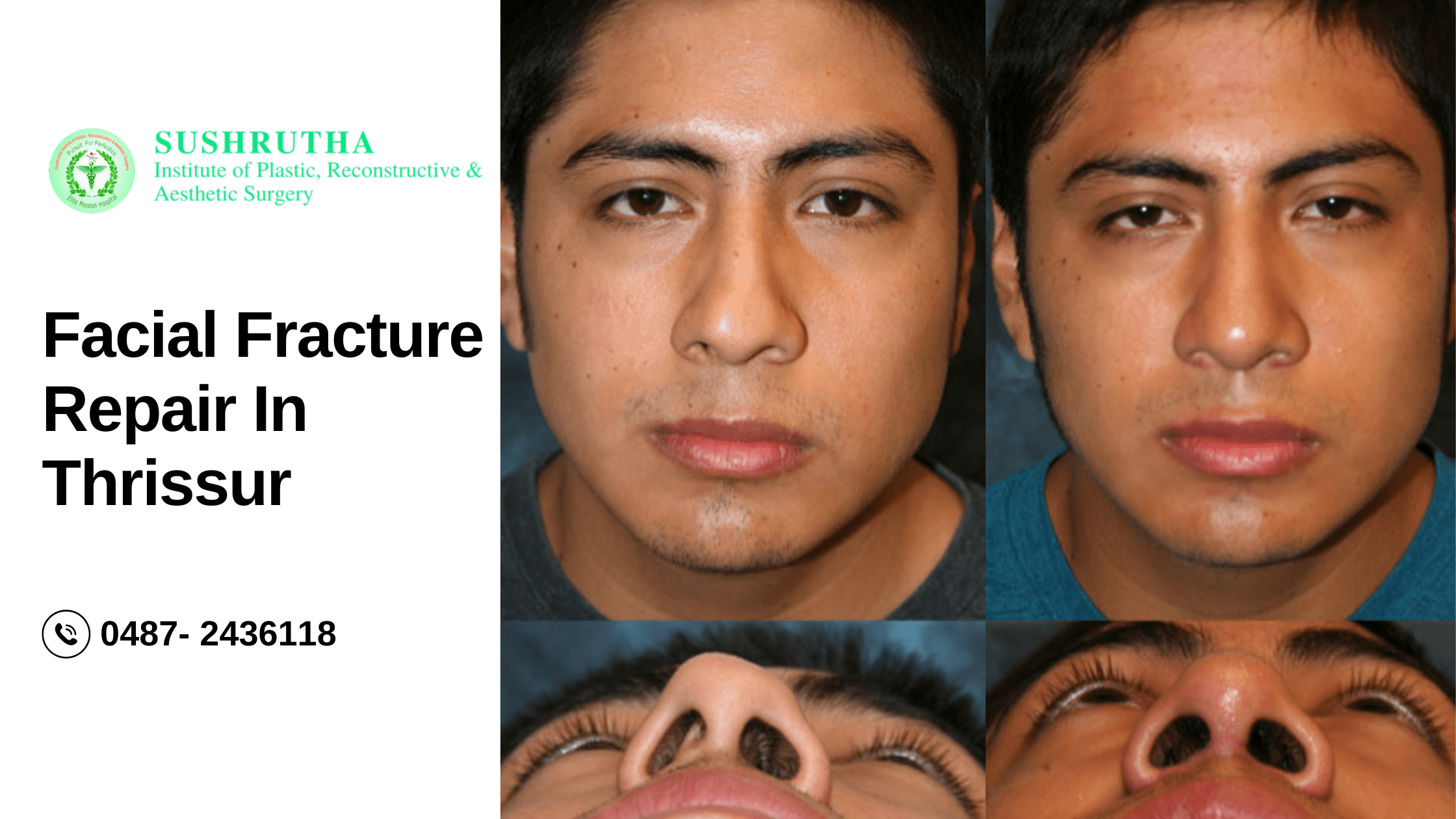 "A team of plastic surgeons at Sushrutha Institute performing advanced facial fracture repair surgery in Thrissur, using state-of-the-art medical technology."