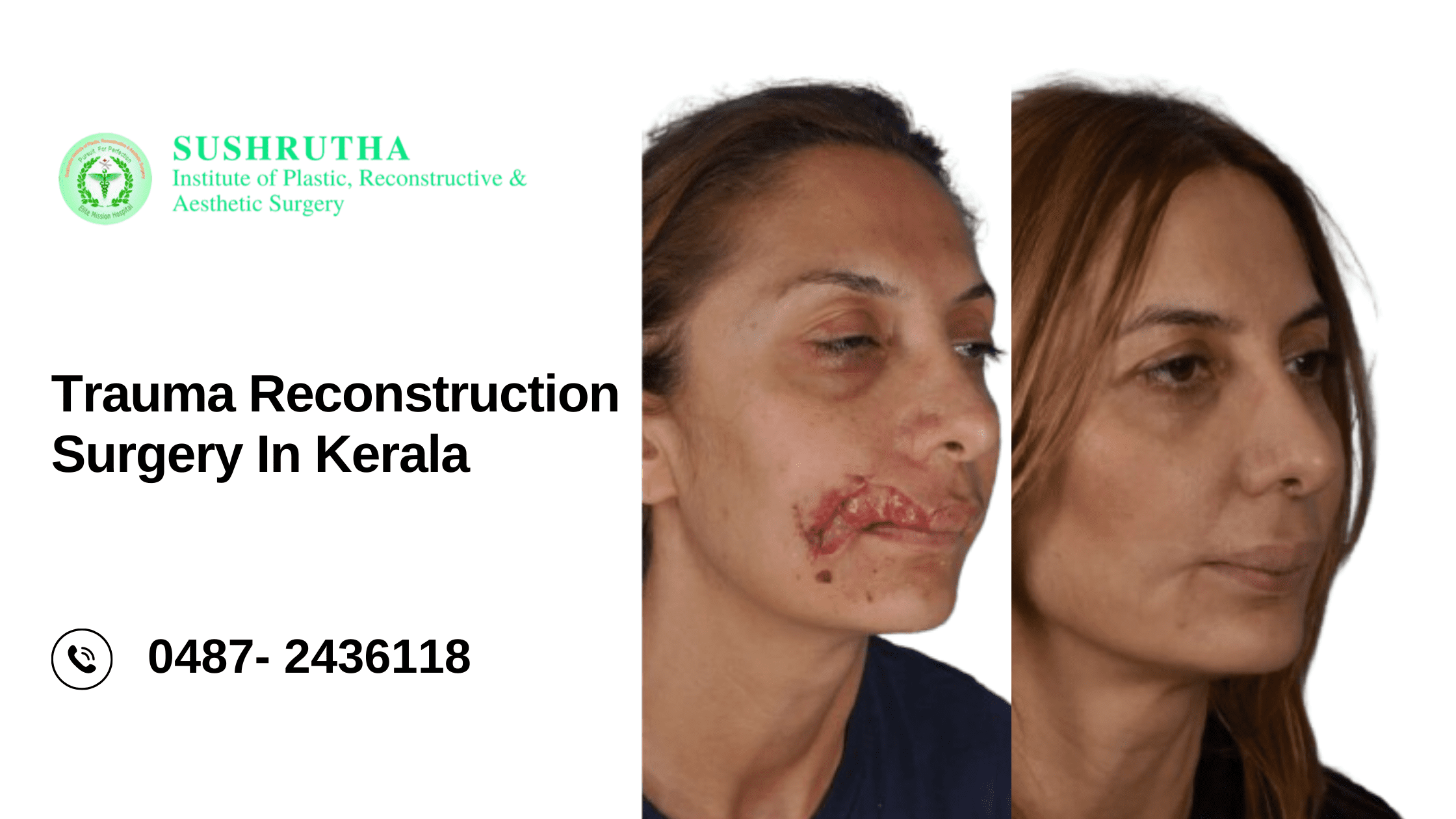 "A team of surgeons performing trauma reconstruction surgery in Kerala, utilizing advanced microsurgical techniques for optimal recovery."