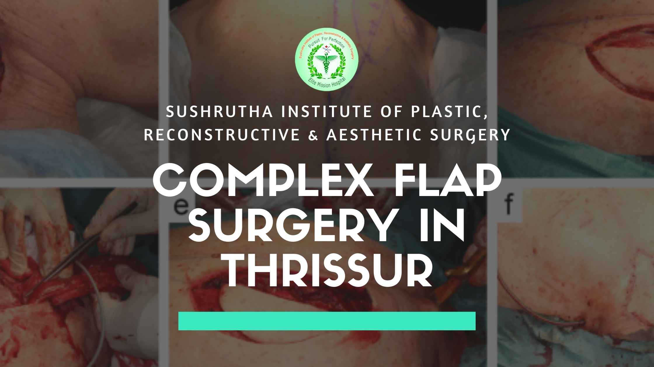 Complex flap surgery at Sushrutha Institute of Plastic, Reconstructive & Aesthetic Surgery in Thrissur.