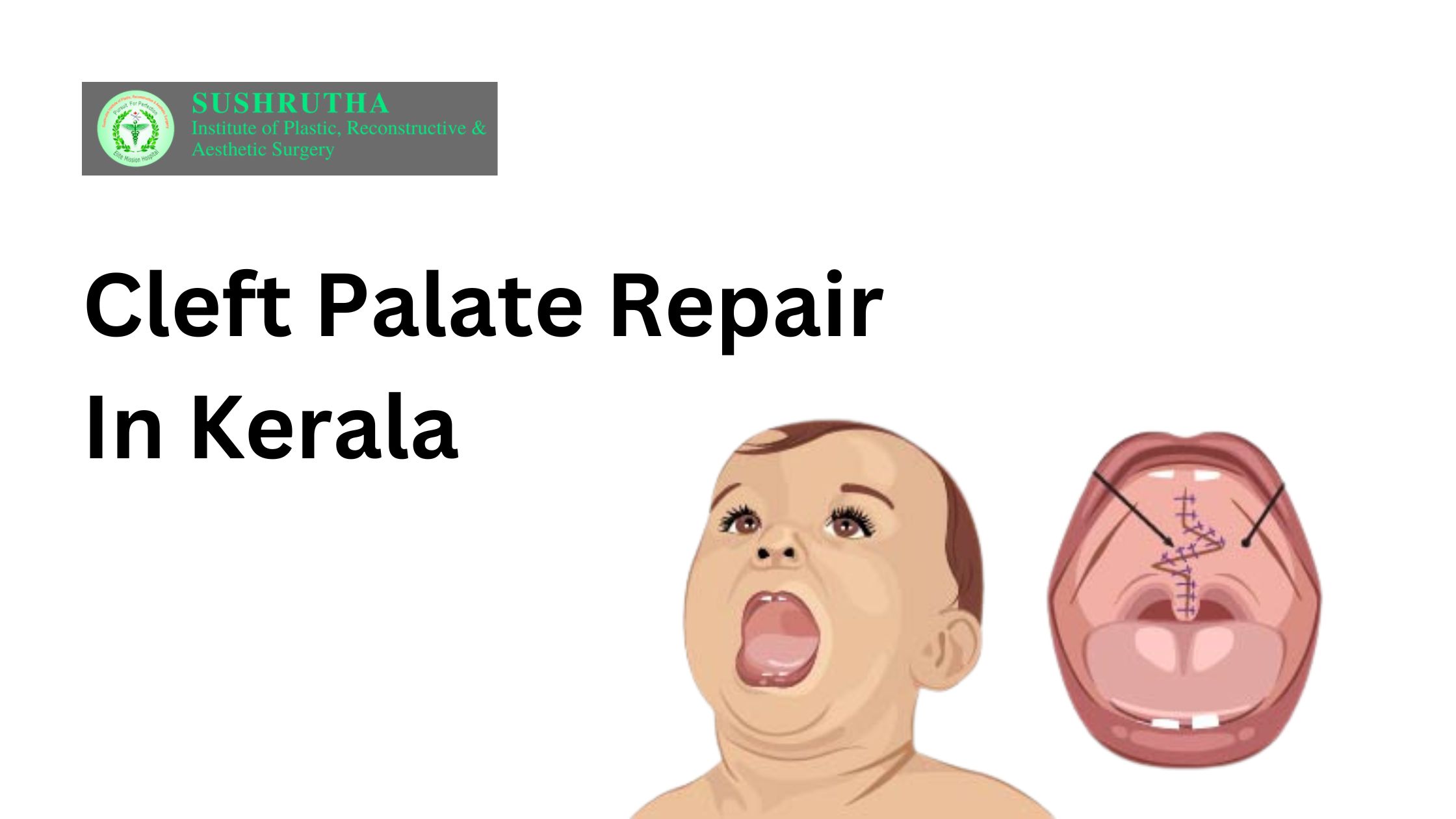 cleft palate repair in Kerala