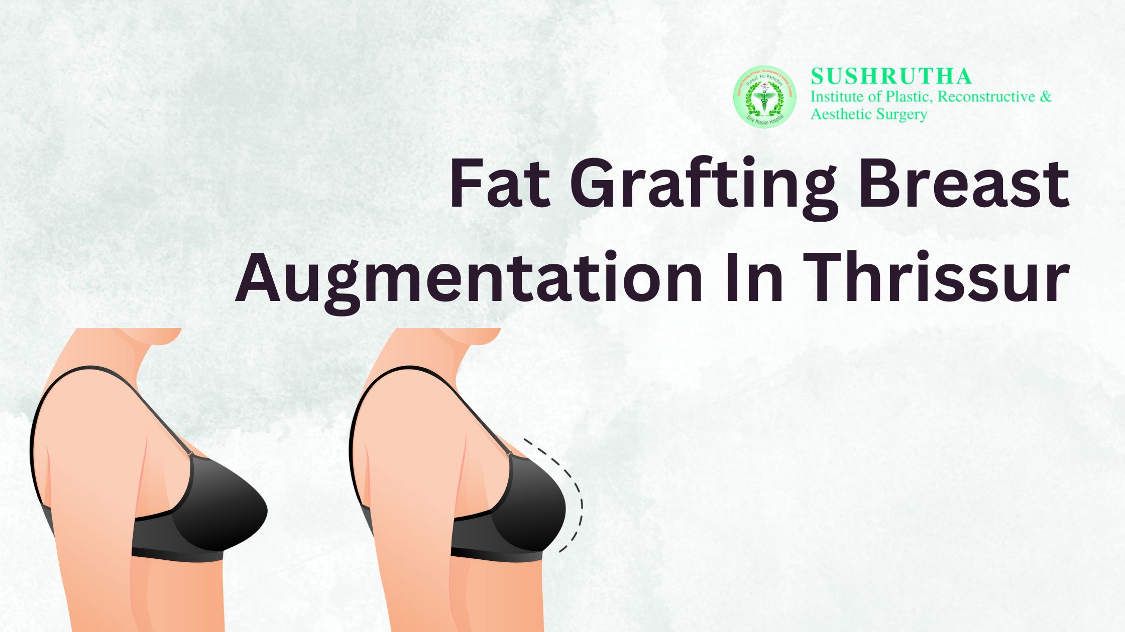 Woman recovering after fat grafting breast augmentation in Thrissur, showing natural-looking results