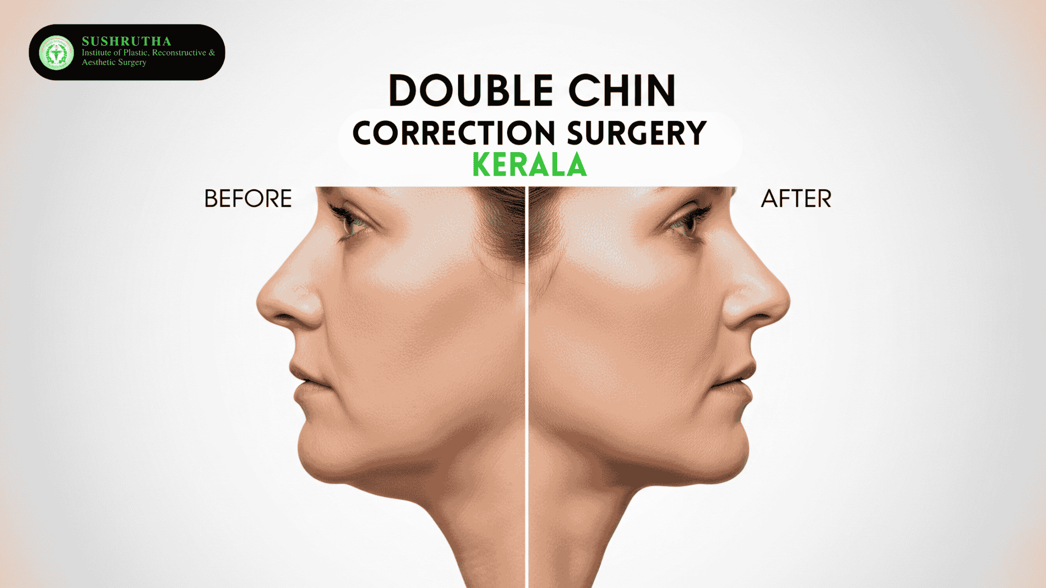 ouble Chin Correction Surgery in Kerala