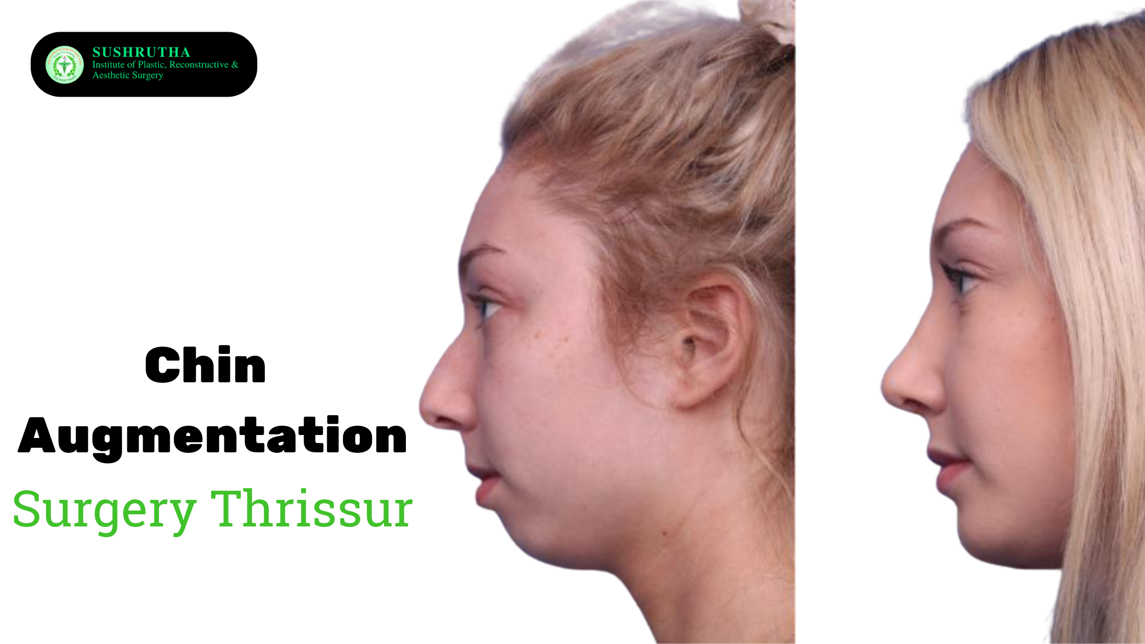 Chin Augmentation Surgery Thrissur