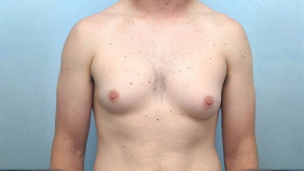 How much does gynecomastia surgery cost
