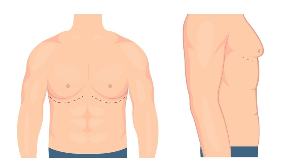 Who is a good candidate for gynecomastia treatment