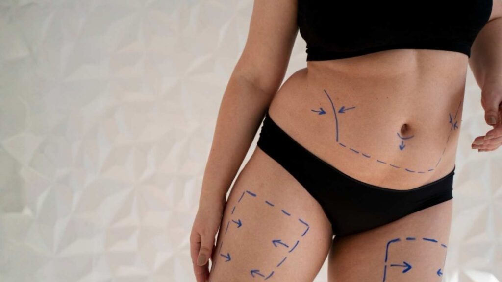 High Definition Liposuction Procedure Steps