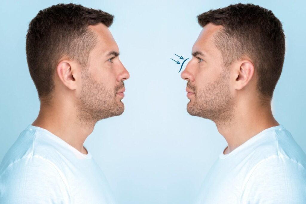 Preparing for Rhinoplasty Surgery illustration showing side-profile nasal assessment and treatment planning for nose reshaping and facial balance.