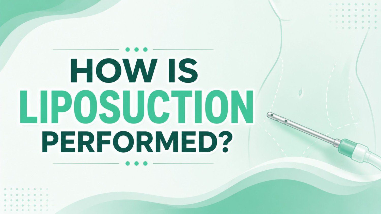 HOW IS LIPOSUCTION PERFORMED? Medical illustration showing a liposuction cannula and abdominal fat removal